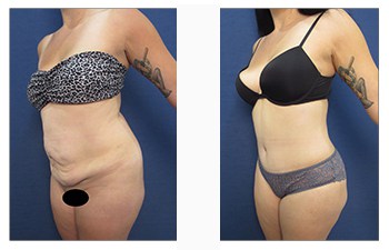 Tummy Tuck for Stomach Pouch - Tummy Tuck Before and After