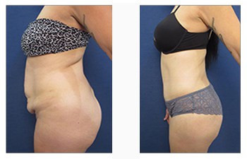 Tummy Tuck Before and Afters