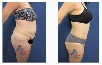 Tummy Tuck Before And After