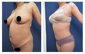 VASER HD lipo with tummy tuck