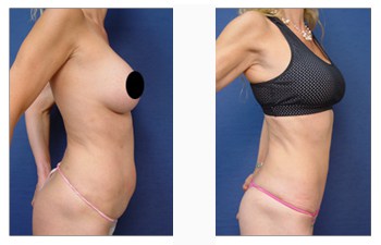 Lipo Abdominoplasty : How to Minimise Scars After Tummy Tuck Surgery