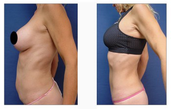 Minimizing Abdominal Incision Line Scarring