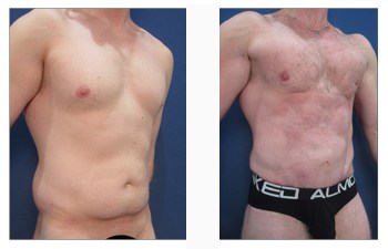 https://cosmeticplasticsurgeryinstitute.com/wp-content/uploads/2019/10/male-square-chest-patient-1-2.jpg