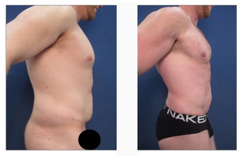 https://cosmeticplasticsurgeryinstitute.com/wp-content/uploads/2019/10/male-square-chest-patient-1-3.jpg