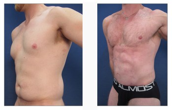 HD Lipo for masculine chest Newport Beach