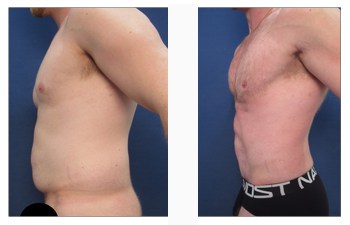 VASER lipo for chiseled abs San Diego