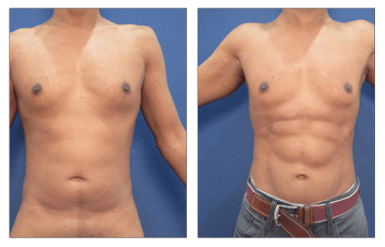 Fat Grafting In Males Cosmetic Plastic Surgery Institute