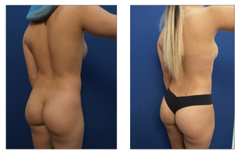 Mini Natural Butt Lift® Beverly Hills, Los Angeles, Mini Butt Lift