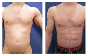 High Definition Liposuction - See our amazing high definition lipo