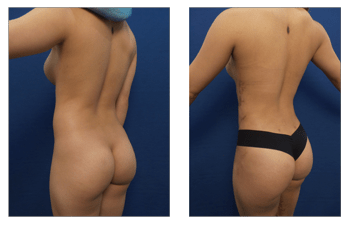 Brazilian Butt Lift Before and After