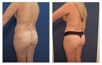 Brazilian Buttock Lift  Harmony Cosmetic Clinic