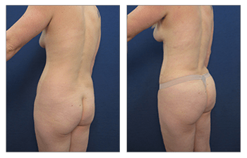 Will A Lower Buttock Lift Make My Buttocks Look Flat Or Square-Shaped? -  Plastic Surgeon