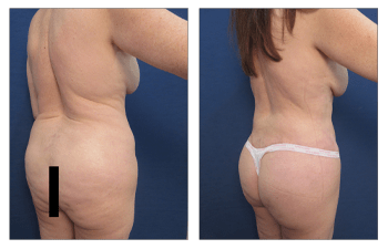 Is Liposuction My Only Option for Body Contouring?, Liposuction Newport  Beach