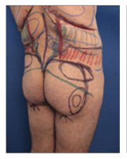 Male Back Liposuction