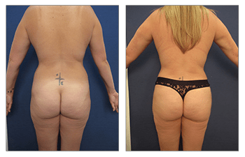 How Can Lipedema Fat Be Managed?