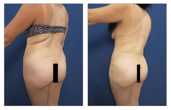 HD liposuction with fat transfer to BBL