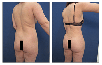 HD liposuction revision with BBL