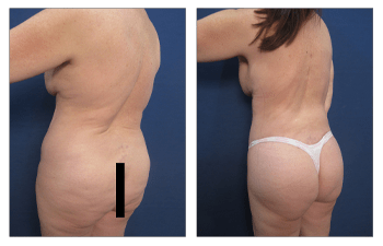 Reverse Abdominoplasty Newport Beach