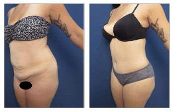 VASER lipo with tummy tuck