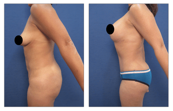 360 lipo with breast implants San Diego