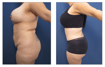 What Is The Cause Of Lipedema