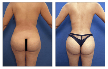 Maximizing Buttock Augmentation