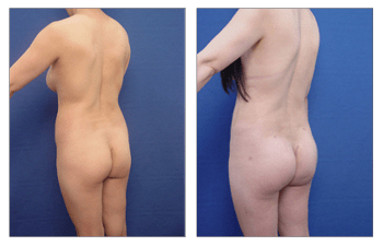 Proper Buttock Implant Placement