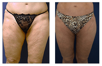 Cellulite  Cosmetic Plastic Surgery Institute