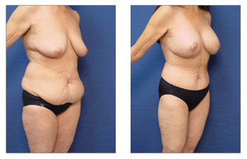 Lipedema vs. Lymphedema: What's the Difference?