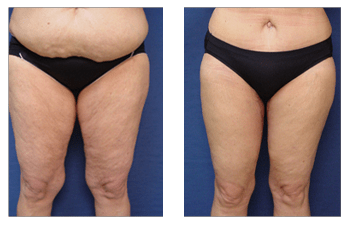 Lipedema, Lymphedema, & Phlebolymphedema: What's the difference