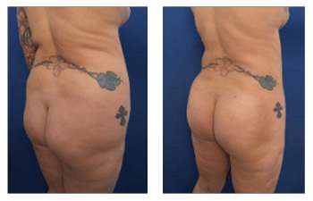 Lipedema Treatment with VASERLipo (Vaser Liposuction)