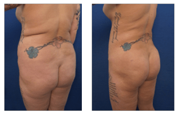 Ideal Treatment Of Lipedema