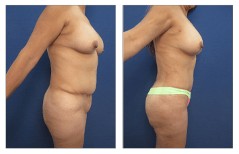 Muffin Top Surgery: Tummy Tuck vs. Liposuction