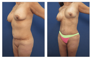 Revision Mini Abdominoplasty - Scar Revision 