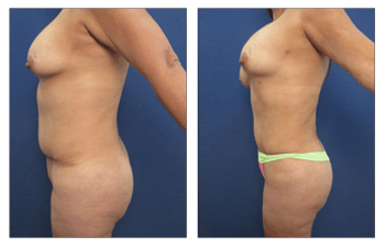 Best tummy tuck revision, Our Surgical Team