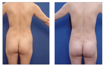 Proper Buttock Implant Placement