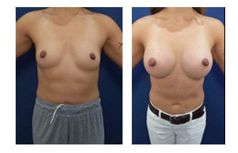 Breast Implant Surgery