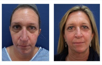 How Is Facelift Surgery Done