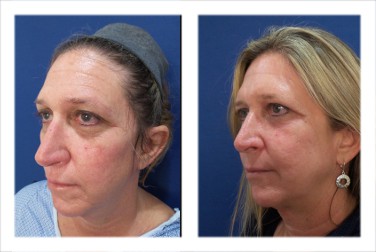 How Is Facelift Surgery Done?