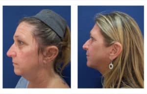 Rhinoplasty