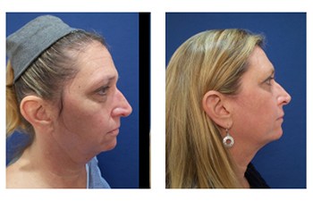 facial rejuvenation surgery Beverly Hills