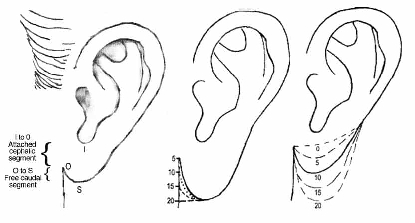 Ideal Earlobe Shape with Every Facelift