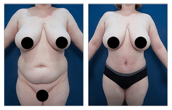 Stomach and Abdomen Liposuction Before and After Photos - Palm Clinic