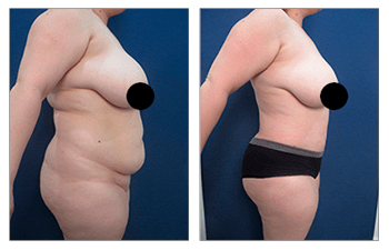 Tummy Tuck and Bilateral Liposuction to Hips - Case #44473 - The