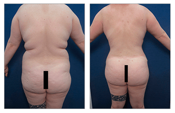 Tummy Tuck - The First Glance