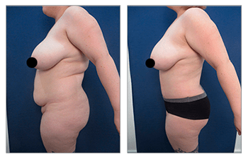 Tummy Tuck - The First Glance