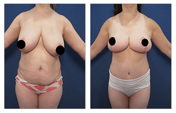 Creating The Best Belly Button For A Tummy Tuck