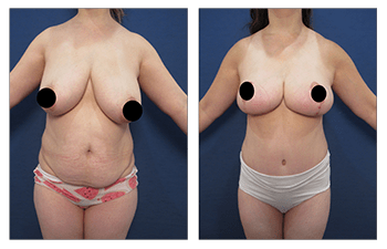 Tummy Tuck Belly Button: Art of Aesthetics