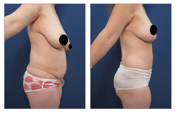 tummy tuck Los Angeles
