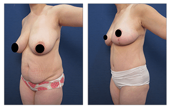 Creating The Best Belly Button For A Tummy Tuck